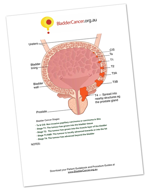Bladder Cancer Big Picture
